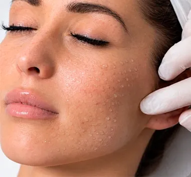 Rostro de mujer con gotas de mesoterapia facial