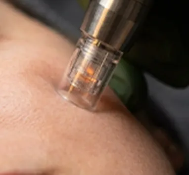 Dispositivo de microneedling sobre la piel